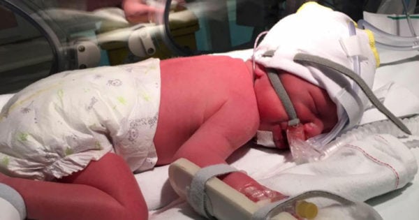 Twin baby died in womb, but Emma carried them both for 15 weeks.