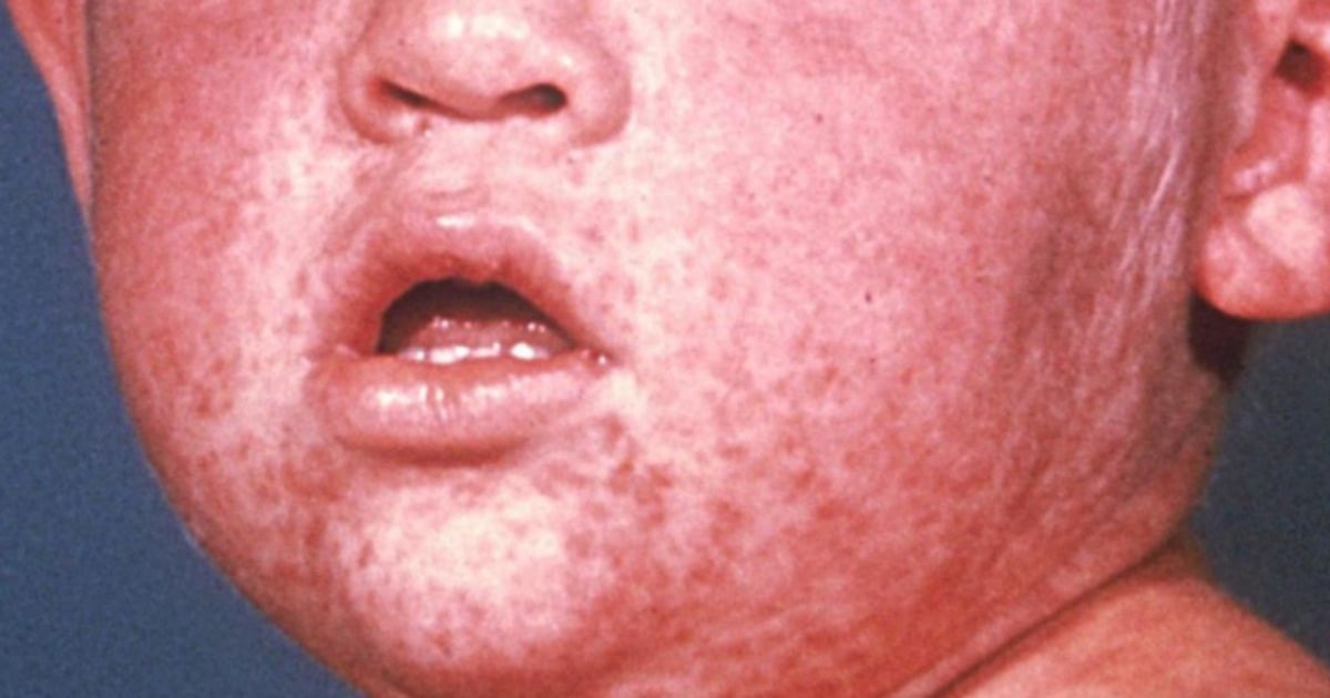 The NSW measles outbreak: This is what you need to know.