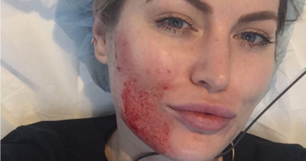 keira vampire facial