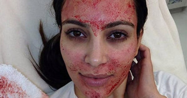 kim k vampire facial