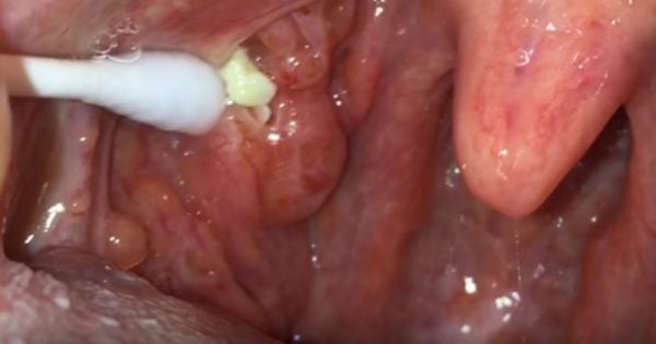 tonsil lump