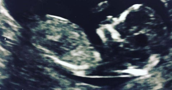 flynn ultrasound