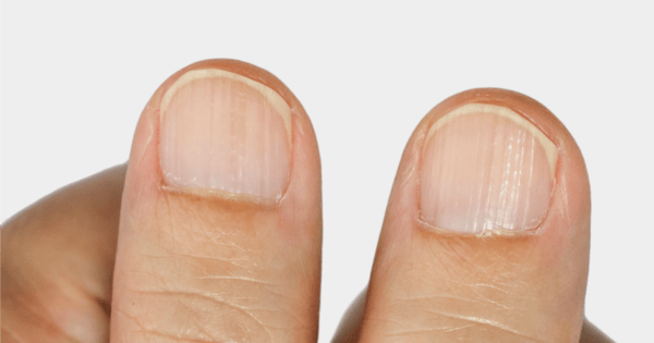 Five things your fingernails can say about your health.