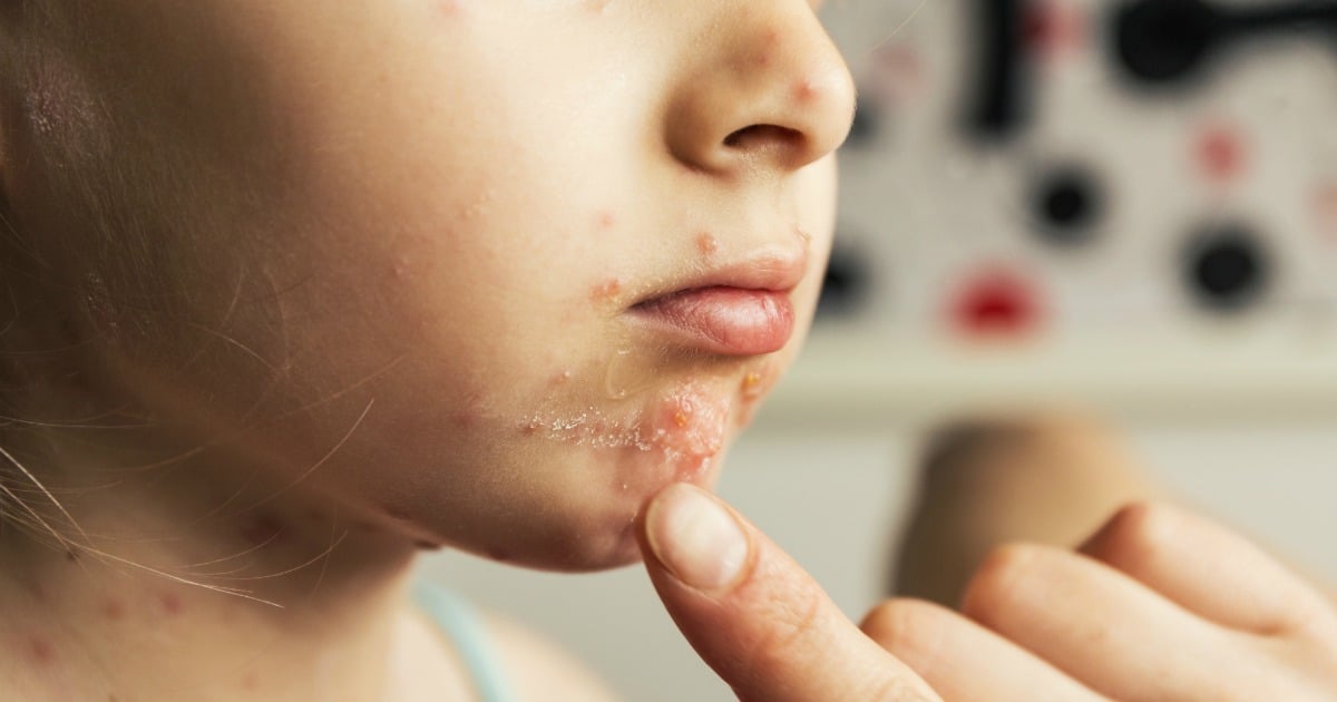 A dermatologist explains exactly how to talk to your kids about child acne.