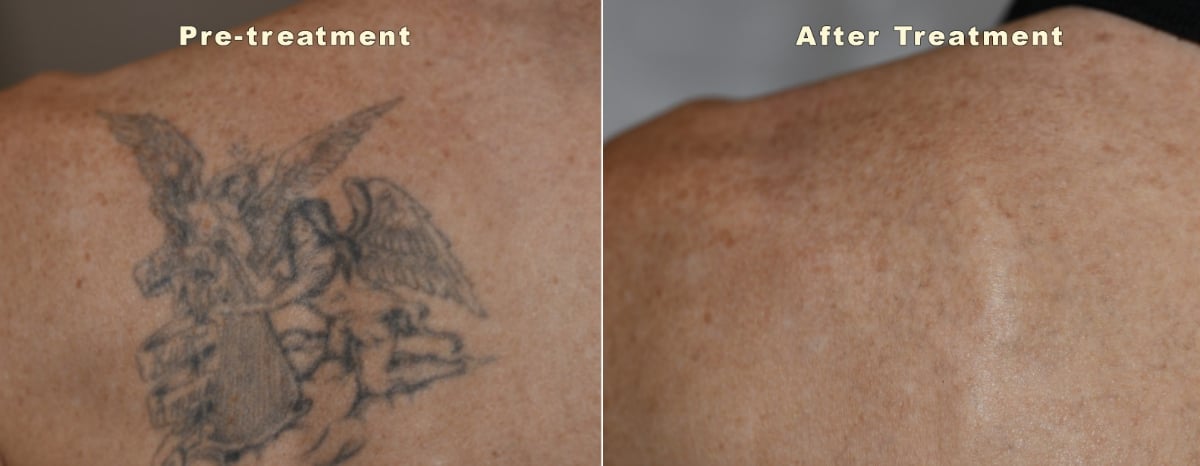 laser-tattoo-removal-before-and-after