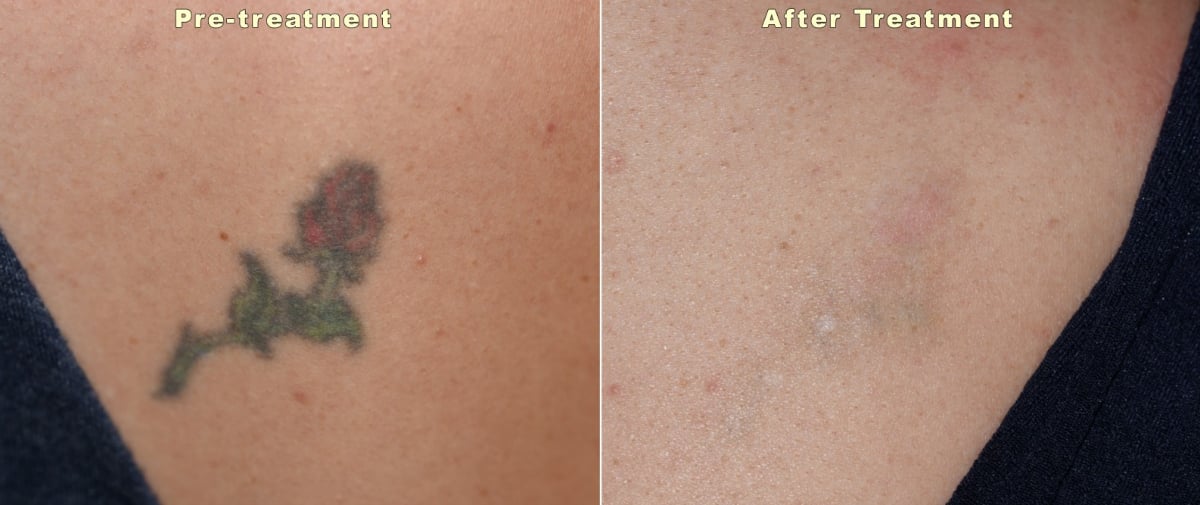 Laser tattoo removal