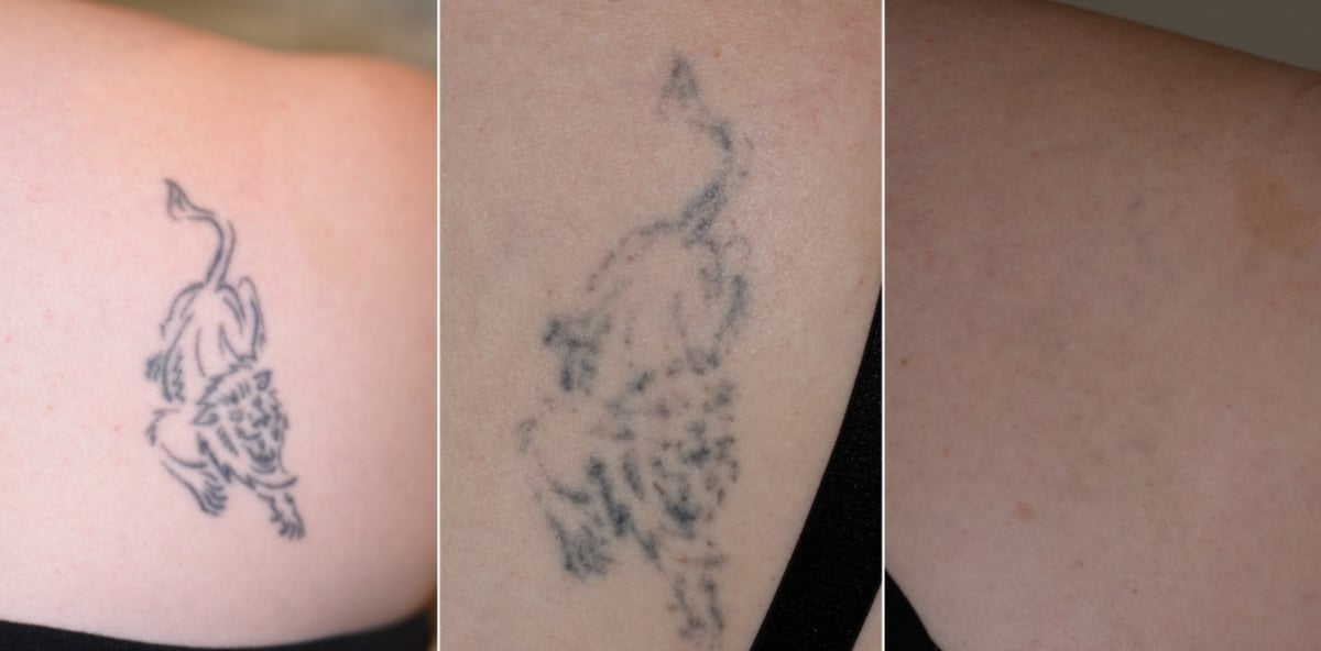 laser-tattoo-removal-before-and-after