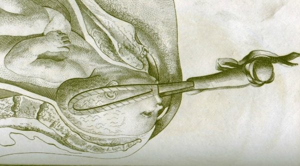 Obstretical-forceps