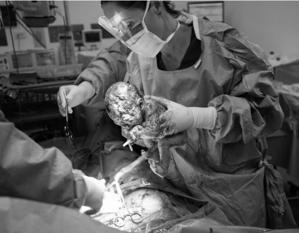 baby born c section