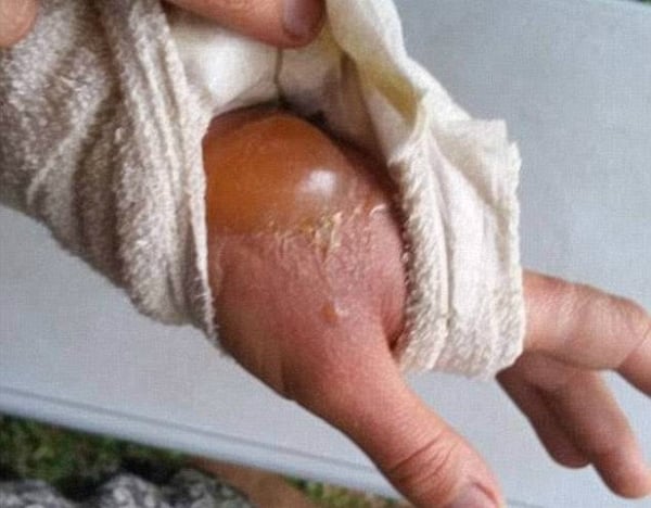 Three-year-old WA girl suffers horrific friction burns after treadmill  accident