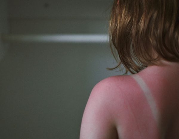 sunburnt child