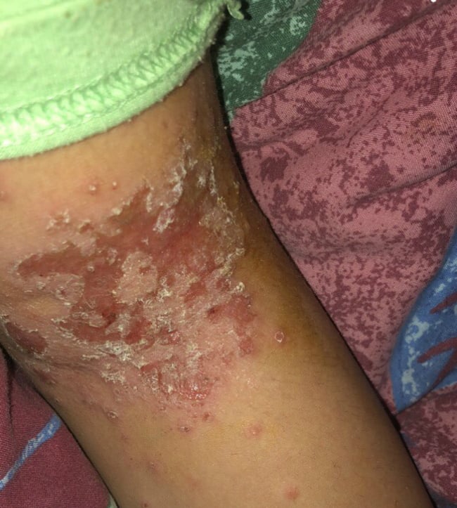 eczema
