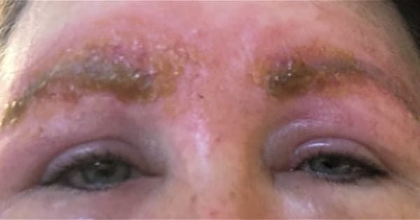 What Is Microblading Usually Safe But This Session Caused A Bad Infection