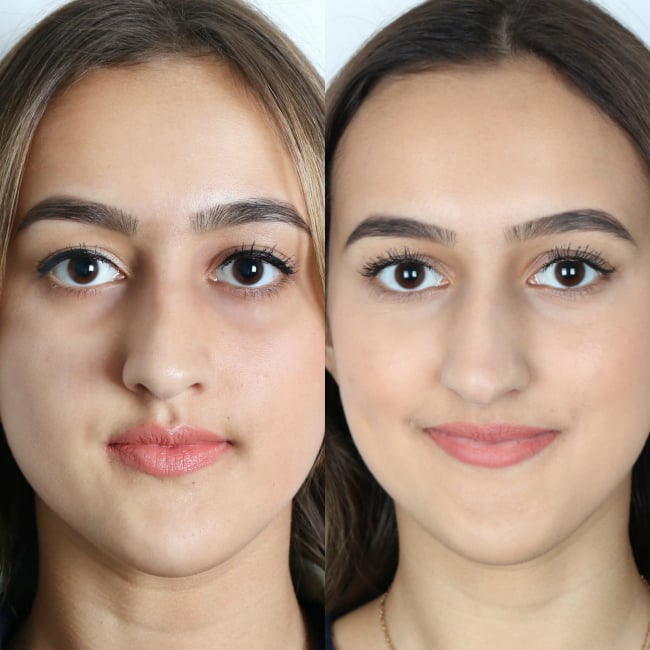 liquid nose job before and after
