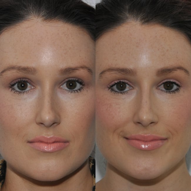 liquid nose job before and after