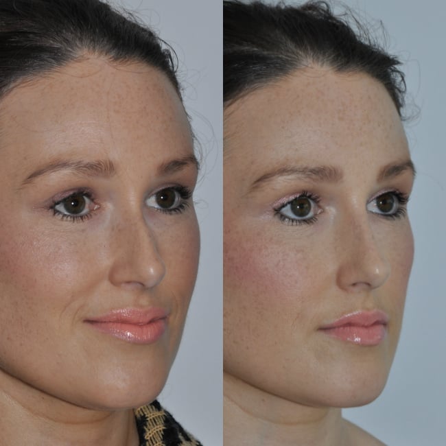 liquid nose job before and after