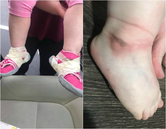 jessica-hayes-daughter-bruised foot