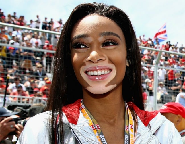 Canadian Grand Prix Model Winnie Harlow What Is Her Skin Condition