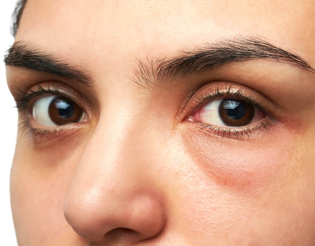 How to Get Rid of Bags Under Eyes and Dark Circles  Dr Axe