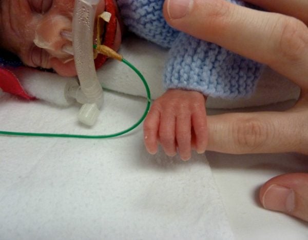 adison premature baby