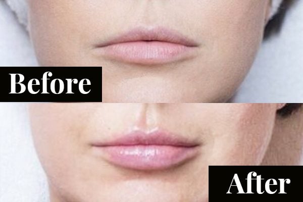 Lip fillers