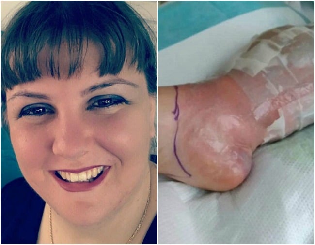 Woman spends weeks in the hospital after getting an infection from a callus  shaver during a pedicure