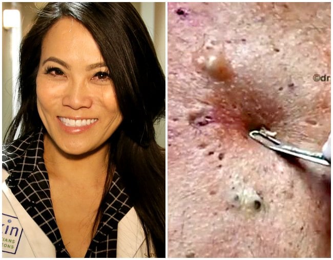 Dr Lee Pimple Popper on the correct DIY pimple popping technique.