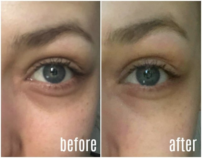 How To Get Rid Of Under Eye Bags Two Methods That Actually Work