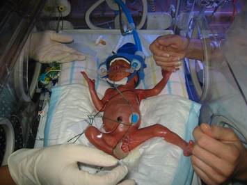 premature baby