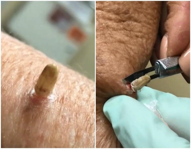 This Video Of Dr Pimple Popper Removing A Cutaneous Horn Is Horrific