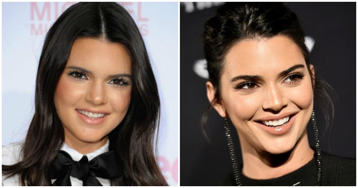 Kendall Jenner Plastic Surgery Why Cant We Talk About It