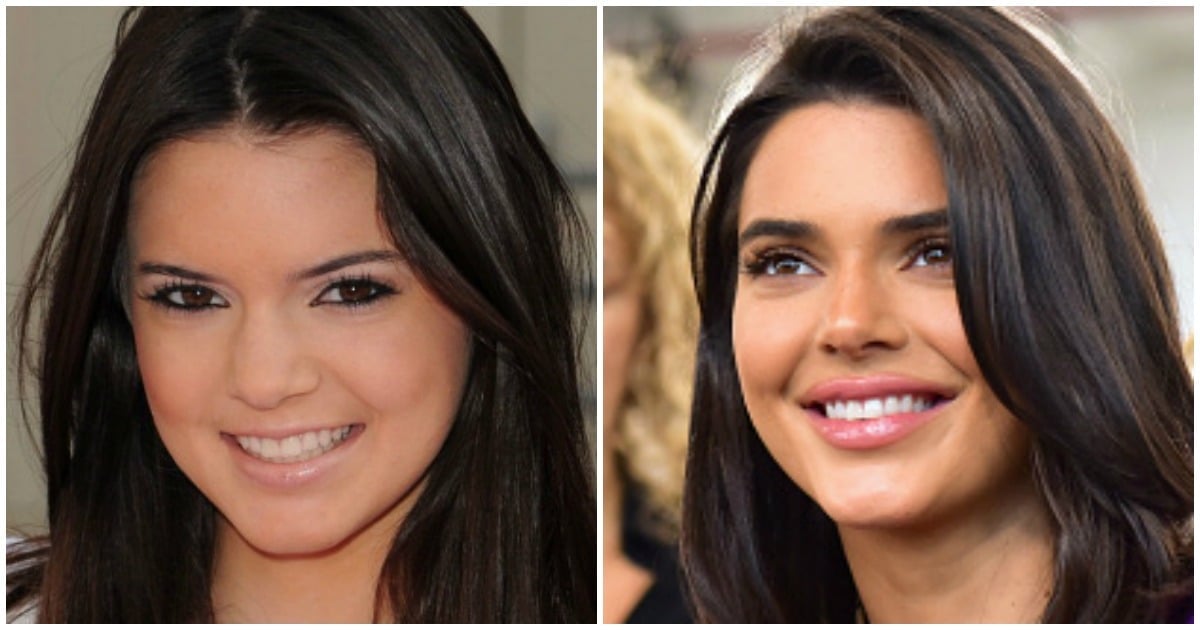 Kendall Jenner Plastic Surgery Why Cant We Talk About It