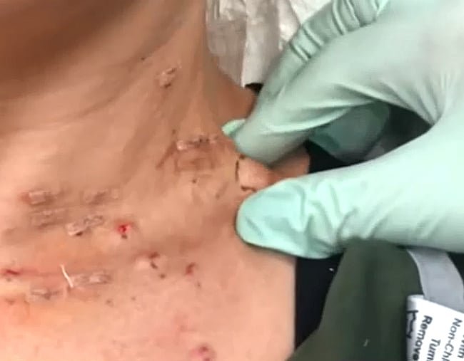 This Dr Pimple 2018 video has been described as "oozing butter".