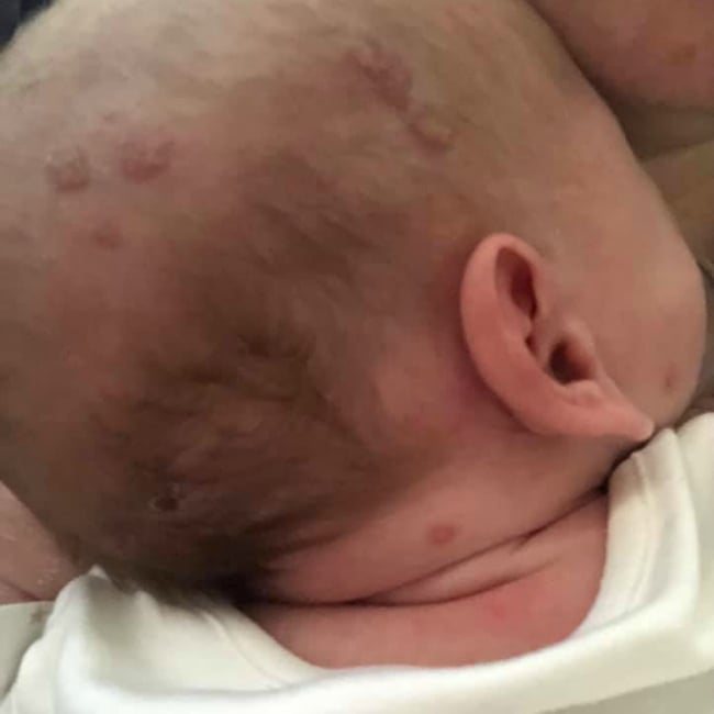 Cold sore on babies head