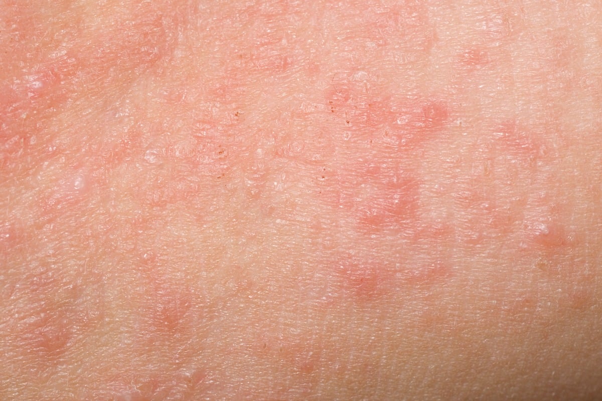 Scabies Mite Rash