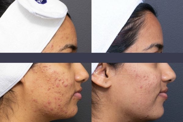 acne-before-and-after