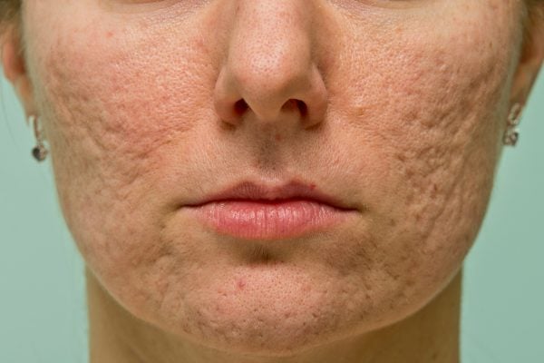 roaccutane side effects