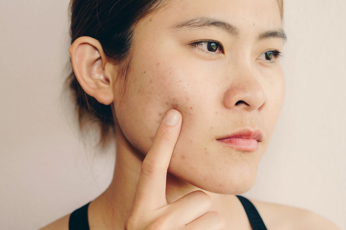 How To Get Rid Of Acne Scars Does Fraxel Laser Work