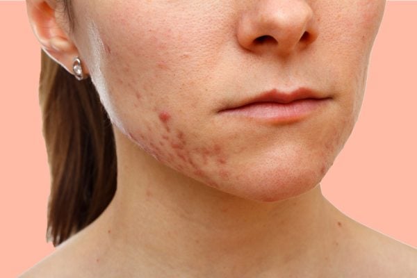 woman-with-acne