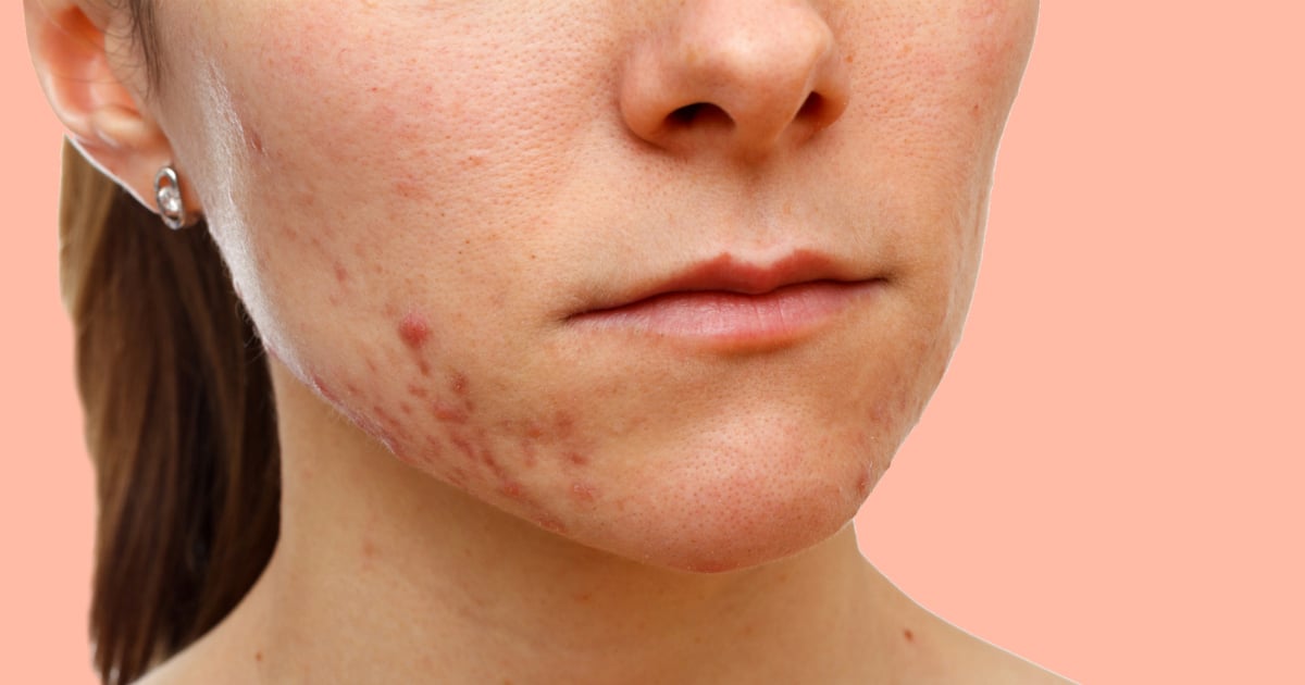 Adult Acne What Causes Adult Acne And How To Get Rid Of It 3552