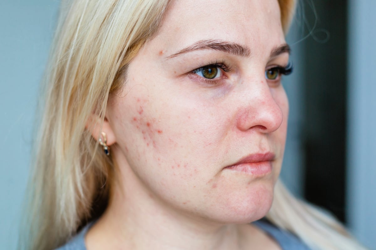 when does acne get better in pregnancy