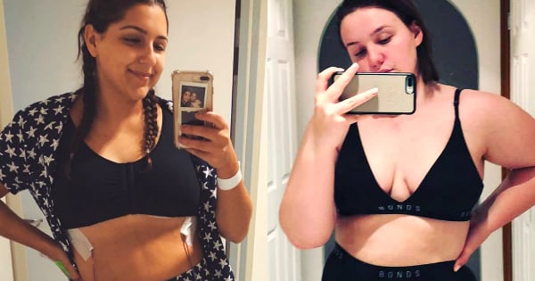 Breast Reduction Before And After In Australia 