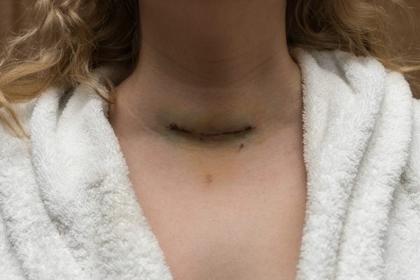 Surgical scar on a woman neck after having thyroid removed. Image via Getty.