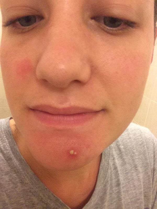 real-women-pimple