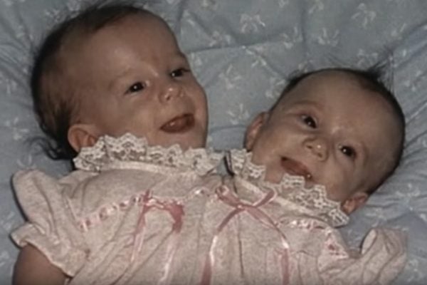 Inside The Life Of Conjoined Twins Abby And Brittany Hensel