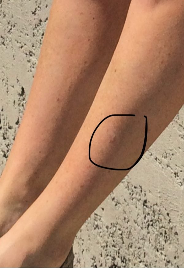 skin-cancer-leg
