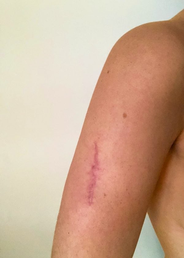 arm-skin-cancer-scar-1
