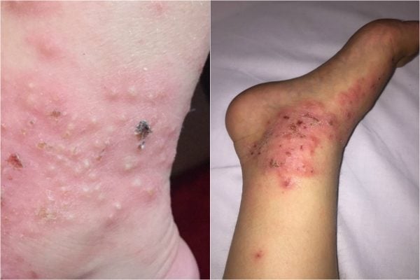 severe eczema