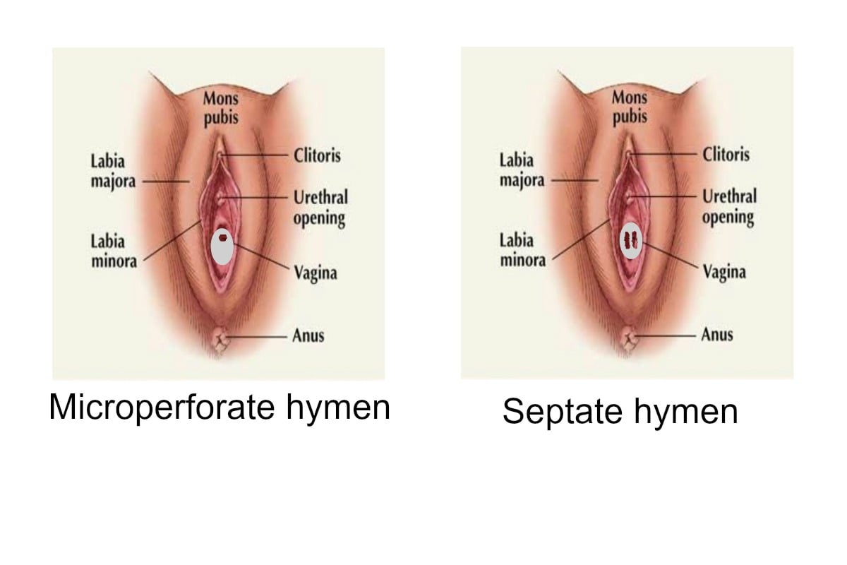 Hymen sex septate Hymen abnormalities: