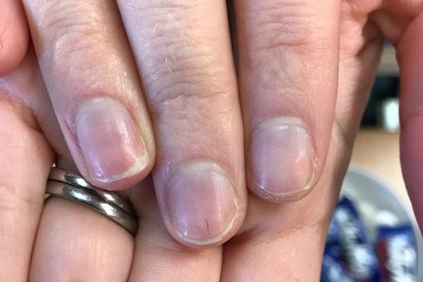 What is nail clubbing? Curved fingernails can signal lung cancer